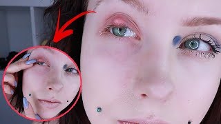 POPPING MY EYE !!  Updating you on my 1 month+ Stye