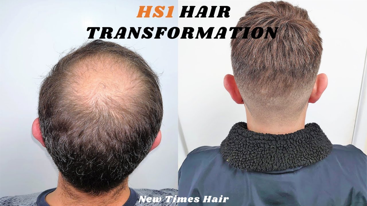 Male Celebrities Who Wear Toupees and Wigs Due to Hair Loss