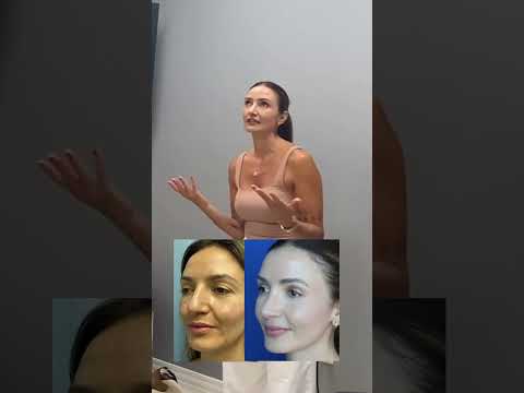 Video thumbnail: My confidence and my life improved substantially after Nosejob!! · Ali Sajjadian