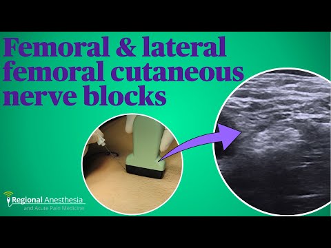 Femoral and lateral femoral cutaneous nerve blocks