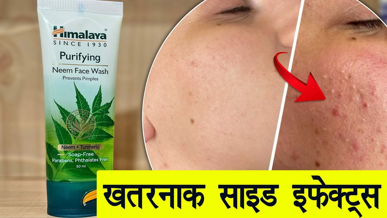 Himalaya Neem Face Wash / Uses, Benefits & How to Apply | Hindi - YouTube