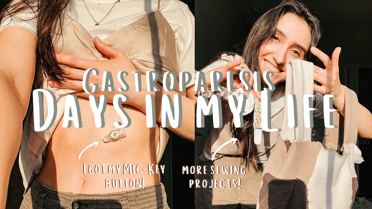 i got a g/j mic-key button! | days in my life with gastroparesis and a feeding tube