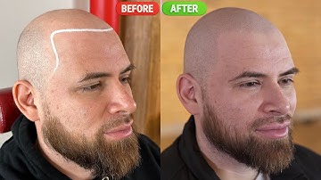 Scalp Micropigmentation Fixes Edgar