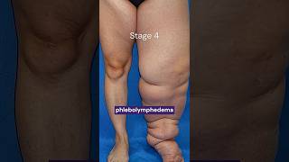 Chronic venous insufficiency or Lymphedema?