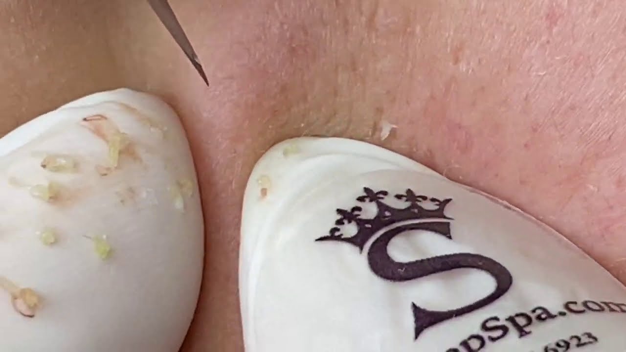 Extractions And Acne  - ThuyTruong#92