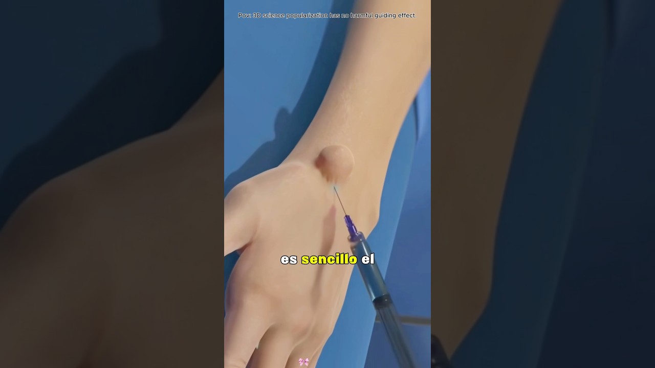 Ganglion Cyst Removal Surgery (3D Animation)#ganglioncyst #handsurgery #cyst #cystremoval