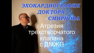 Атрезия трехстворчатого клапана с ДМЖП