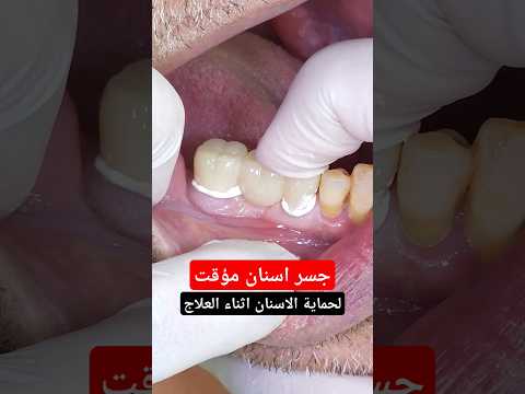 جسر اسنان مؤقت