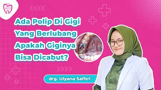 Polip Gigi di Gigi Berlubang: Apakah Bisa Dicabut dengan Aman?