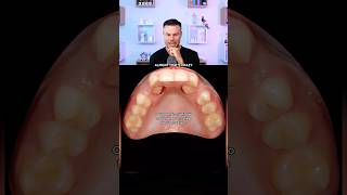 Dentist Reveals The Most Common Impacted Teeth