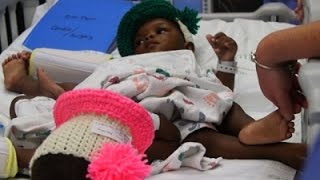 Conjoined Twins Successfully Separated