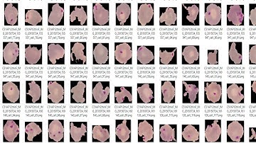 Malaria Detection Using Deep Learning