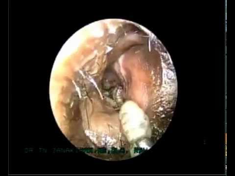 Maggots in Nose - YouTube