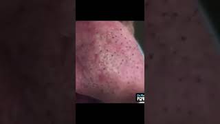 Massive Blackhead Extraction Haul
