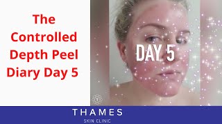 7. Day 5 Following The Controlled Depth Peel