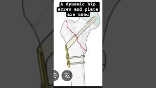 Hip Fractures and how they are treated #health #orthopedic #osteoporosis