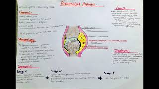 Rheumatoid Arthritis, synovitis - overview