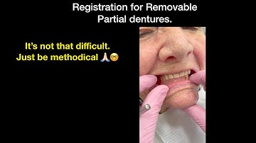 Registration sequence for a removable partial denture