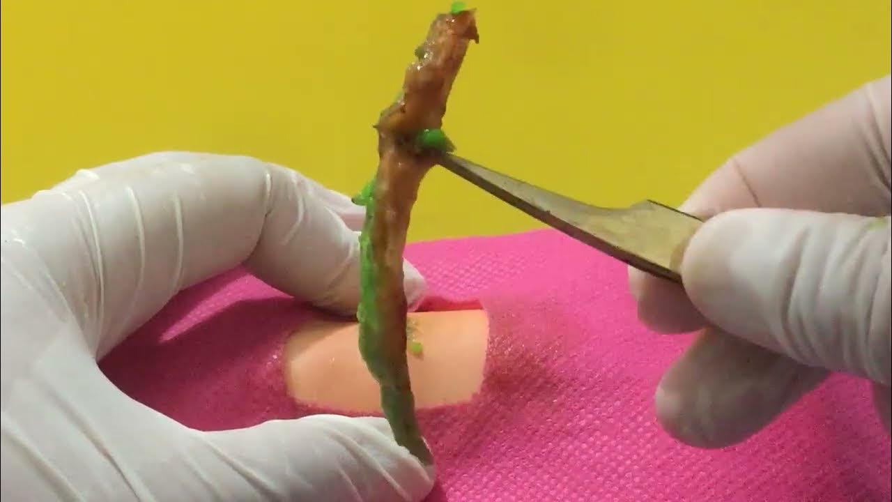 BEST Pimple Popping // Big Cystic Acne Blackheads / Whiteheads Removal