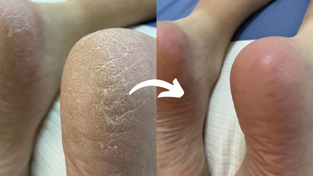 Satisfying Dead Skin Removal From Dry Feet Using 3 Different Tools