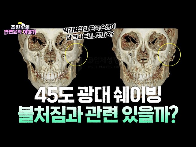 광대뼈 쉐이빙하면 살이 처진다는건 사실이 아닙니다. (feat.230도입체광대축소술)