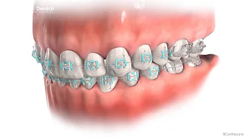 ¿Cuánto tardan los brackets en bajar los dientes caninos?