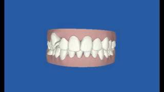 Clincheck Treatment Movie