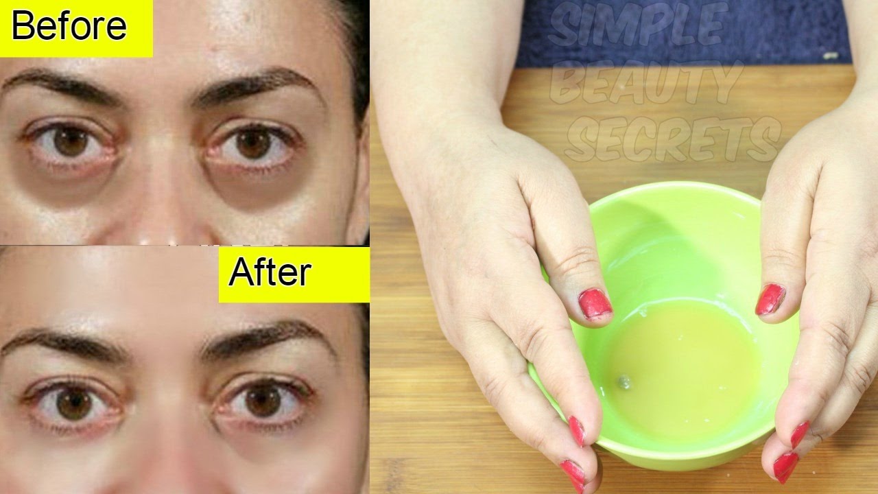 How To Remove Dark Circles Naturally At Home काले घेरे दूर करने के लिए