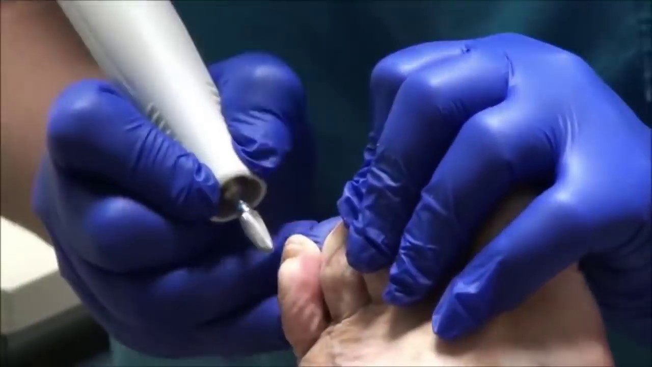 Diabetic Nails Treated Diabetes, Nails, Calluses, and Shoes YouTube