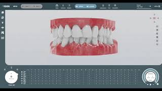 SoftSmile Setup | CAD/CAM Dentistry screenshot 2