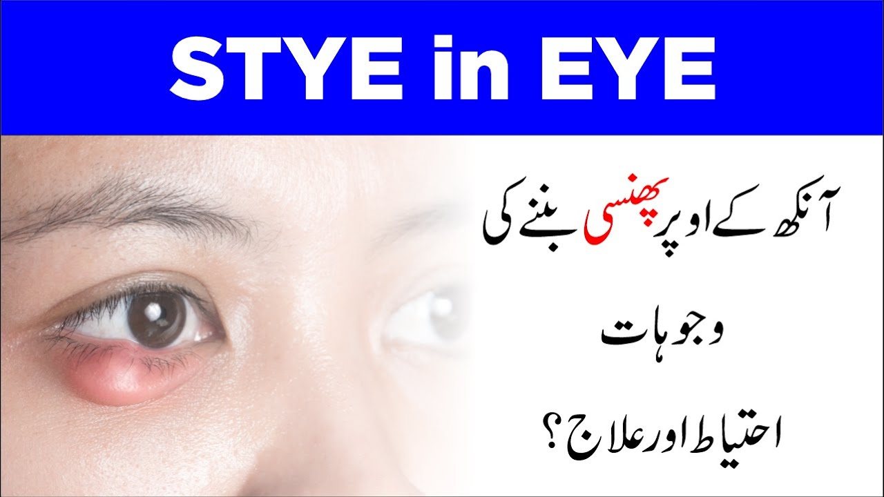 Understanding Stye in Eye Causes, Symptoms, and Treatment Eye Health