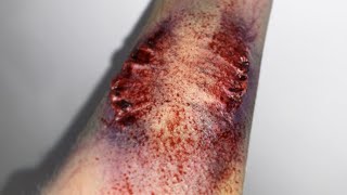 Zombie Bite Severe Bruising Sfx Makeup Tutorial Quick & Easy