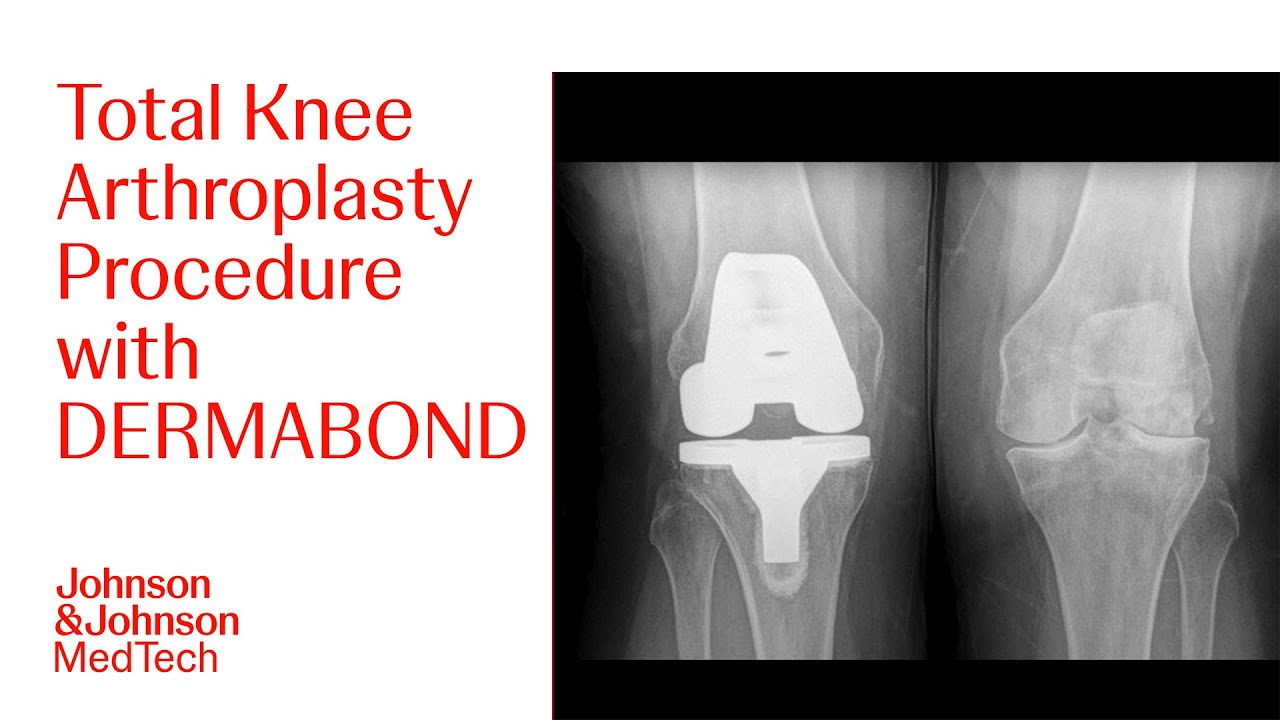Total Knee Arthroplasty Procedure Using DERMABOND PRINEO and STRATAFIX ...
