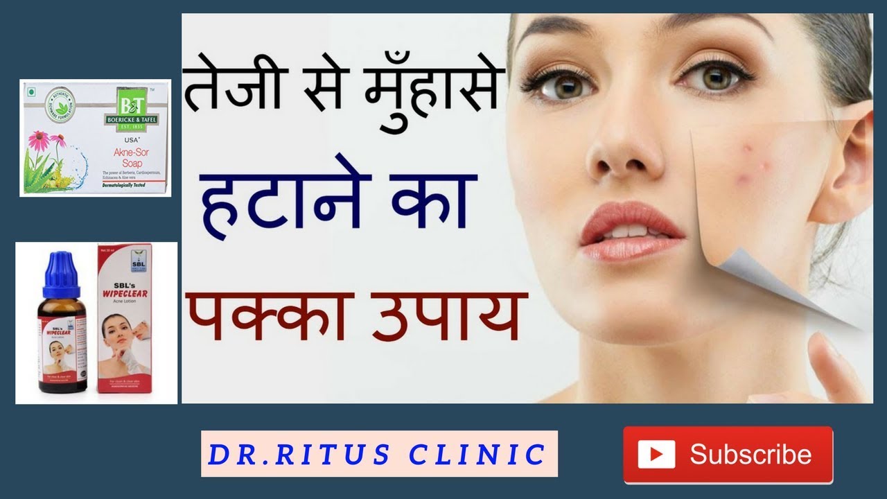 मुहासे का होम्योपैथिक इलाज - Pimple & Acne Treatment - Cure For