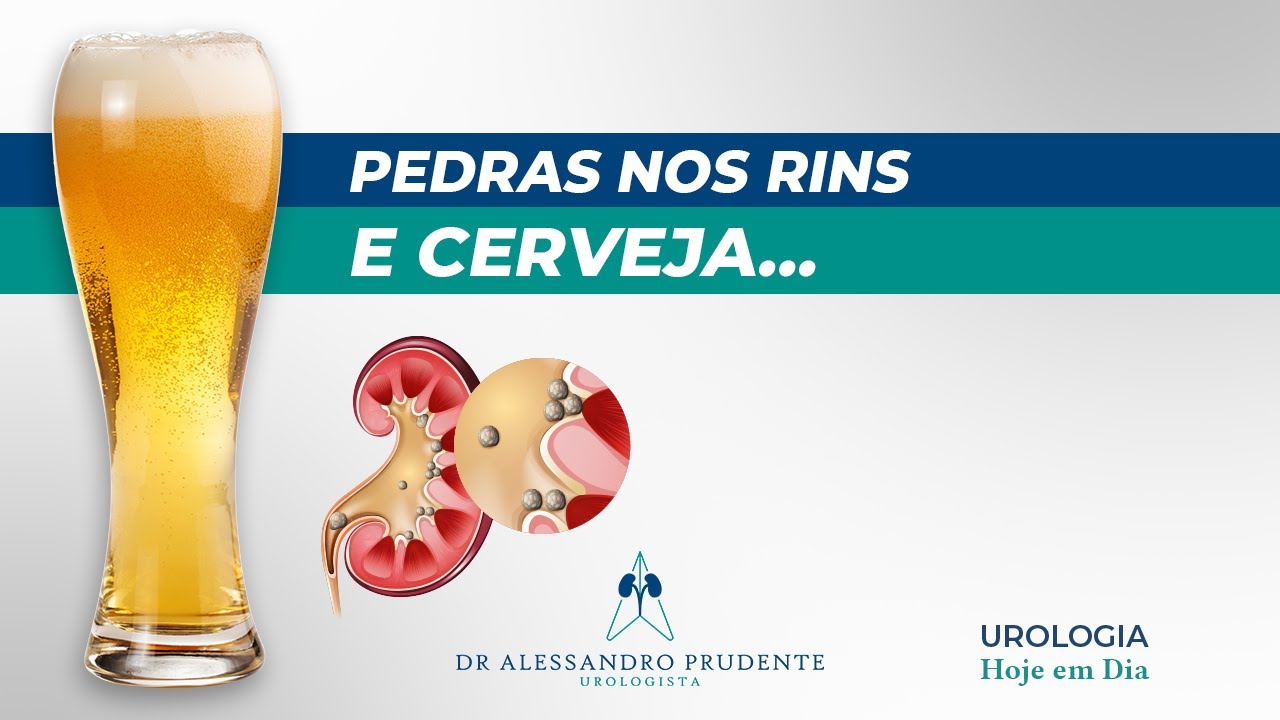 Quem Tem Pedras Nos Rins Pode Tomar Cerveja? | Dr. Alessandro Prudente ...