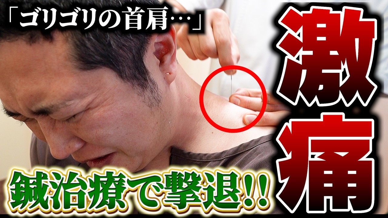 肩甲骨のゴリゴリ感…慢性肩こりの"真犯人"を鍼で撃退【鍼灸】