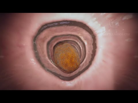 Video: Vienkāršas Apakšstilba Kaulu Cistu ārstēšana Ar Intramedulāru Naglu Ievadīšanu Un Steroīdu Injekciju