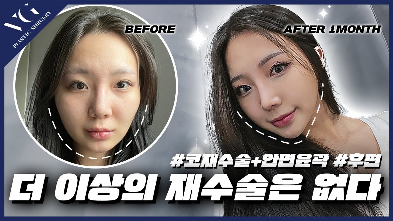 [Веригүд гоо сайхны мэс заслын клиник] Хамрын дахин давтан мэс засал болон нүүрний хэлбэр засах мэс заслын үр дүнд шинээр төрсөн нь ✨ | Хамрын давтан мэс засал, нүүрний хэлбэр заслын нэг сарын дараах бодит сэтгэг