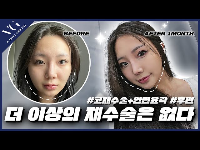 코재재수술 + 안면윤곽 으로 새로 태어남✨ㅣ코재수술,안면윤곽 한달 차 리얼후기
