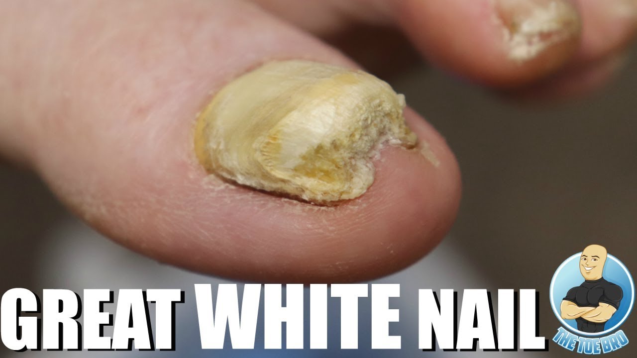 White Spots On Toenails Fungus