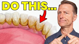 The 1 Top Remedy for Dental Plaque (TARTAR)