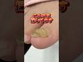 【肥厚爪ケア】#shorts