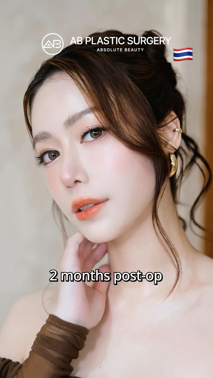 Her Final Revision Rhinoplasty in Korea #shorts