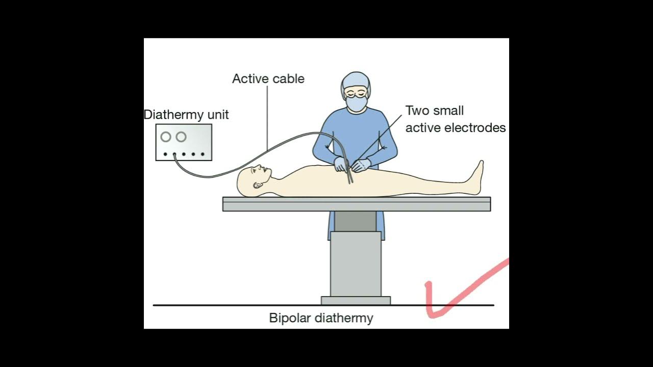 Diathermy used in surgery YouTube