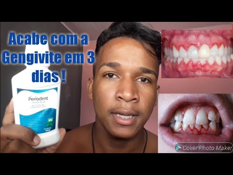 Como acabar com a gengivite EM TRÊS DIAS !!! - YouTube