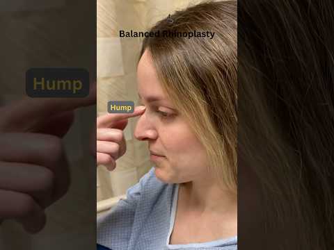 Video thumbnail: Big Hump | Droopy Nose | Intra Operation! — Ali Sajjadian
