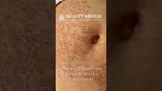 Stretch Mark Treatment