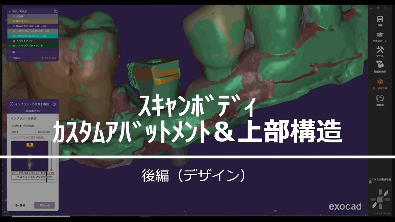 how to exocad インプラントモジュール スキャンボディからカスタムアバットメント＆上部構造 後編（デザイン