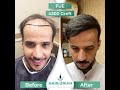 Hair transplant turkey hair of zrian fue 4300 graft