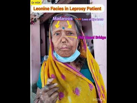 Leonine Facies (Lion like Face) in Leprosy patient.... 🦁कुष्ठरोग